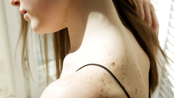 soleil et mélanome : protéger sa peau et repérer les signes qui doivent alerter