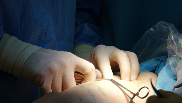 	Chirurgie bariatrique : comprendre sleeve, anneau et bypass
