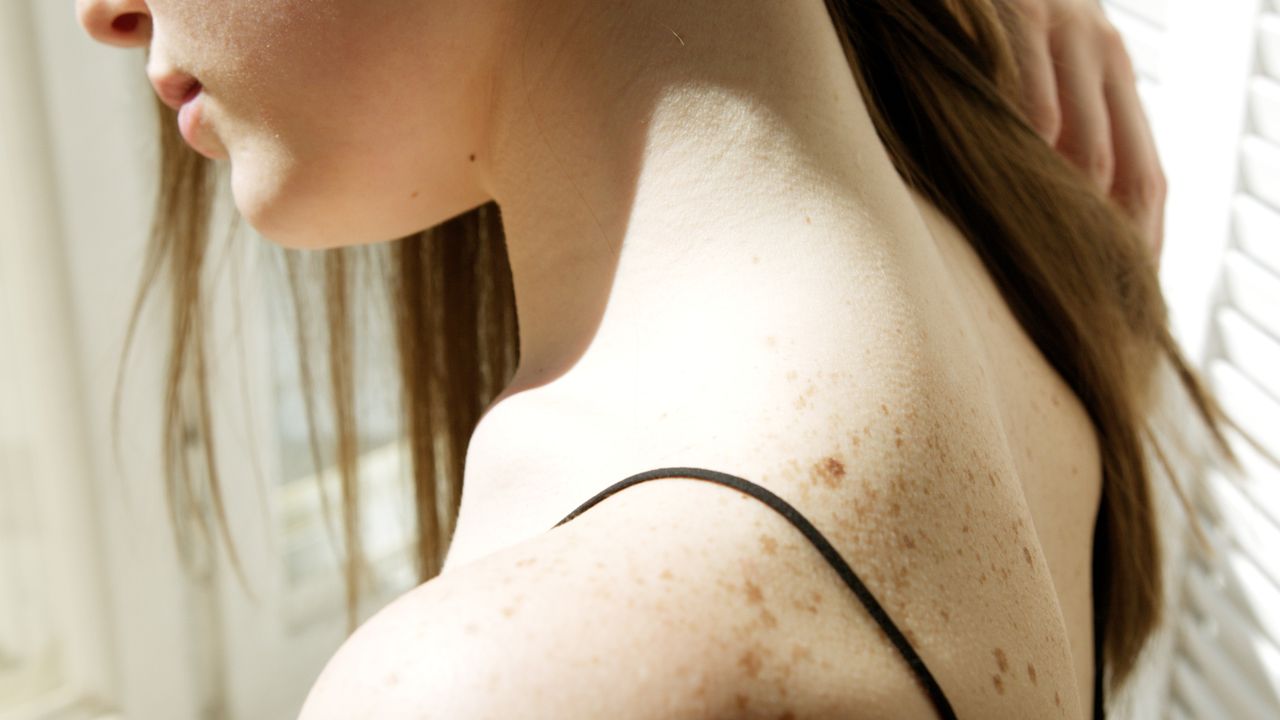 soleil et mélanome : protéger sa peau et repérer les signes qui doivent alerter