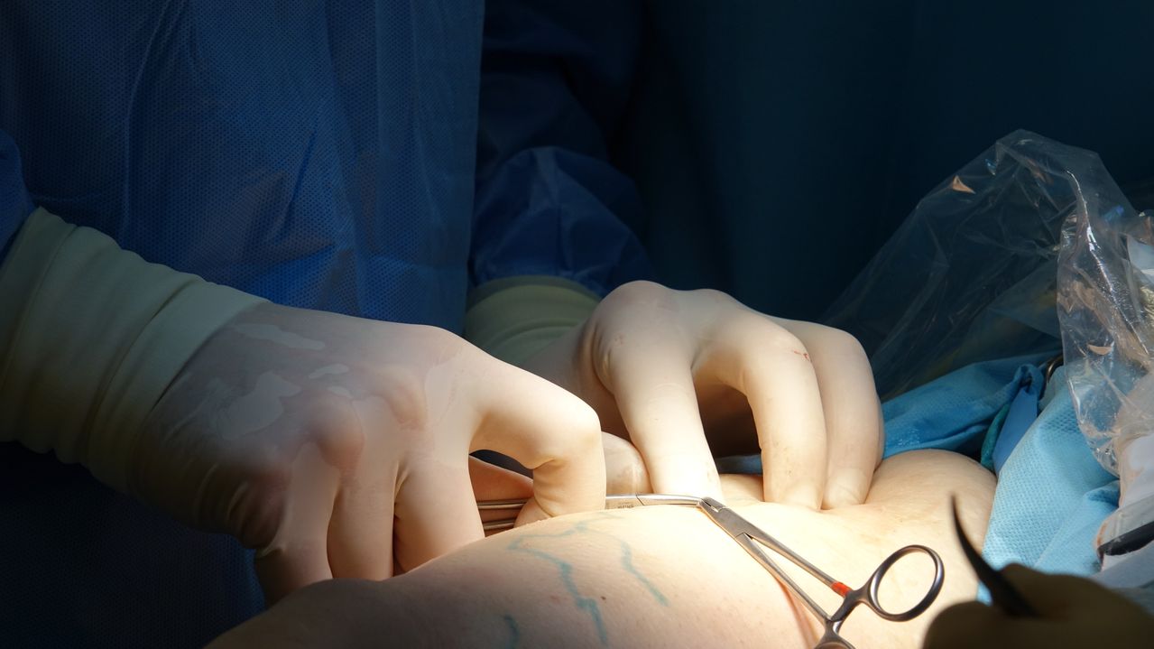 	Chirurgie bariatrique : comprendre sleeve, anneau et bypass